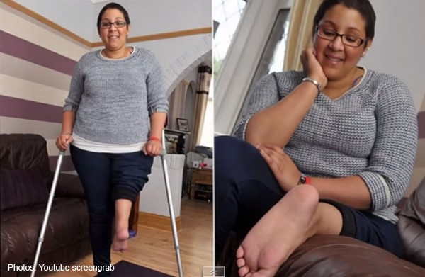 Woman with bone cancer gets new 'knee' with foot attached backwards
