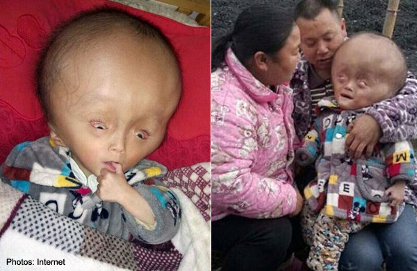 Disease causes boy's head to swell double its size