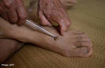  Bee sting therapy causing a buzz in China