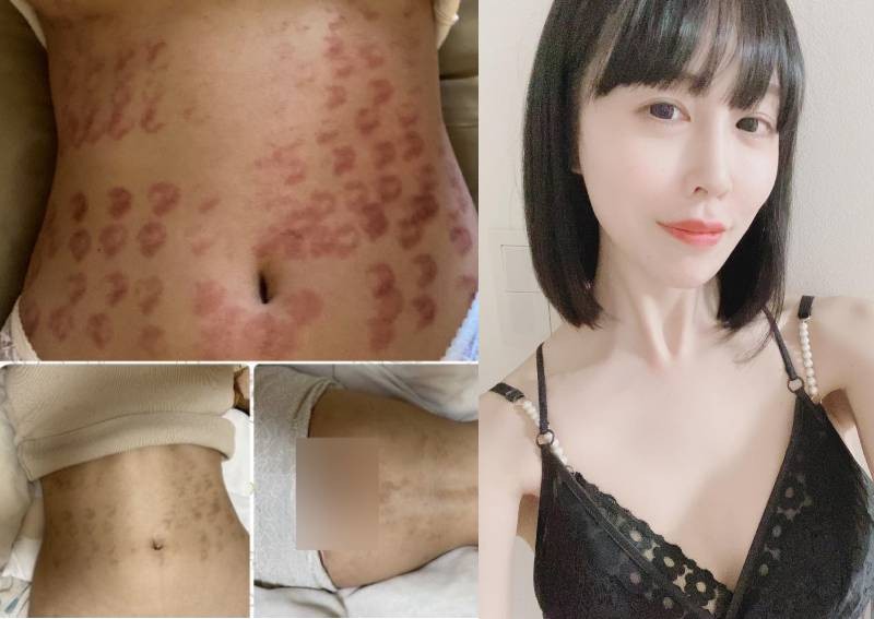 Japanese AV star Riri Hosho reveals she suffered burns across body from hair removal procedure gone wrong