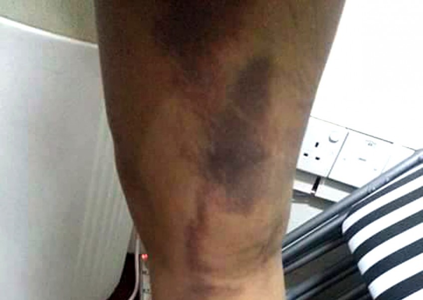 Abused maid says employer used metal hanger, rod to hit her