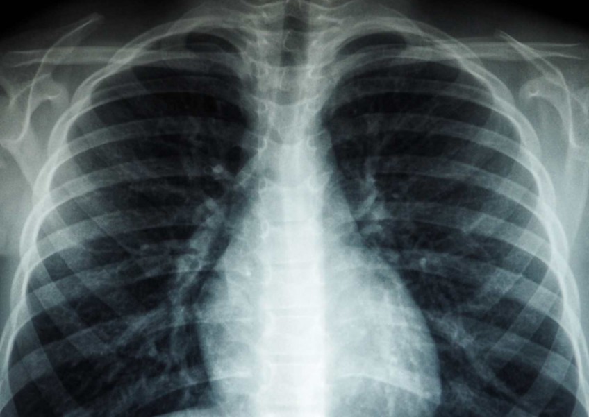 Tackling tuberculosis: How Singapore is taking a proactive stance against the disease