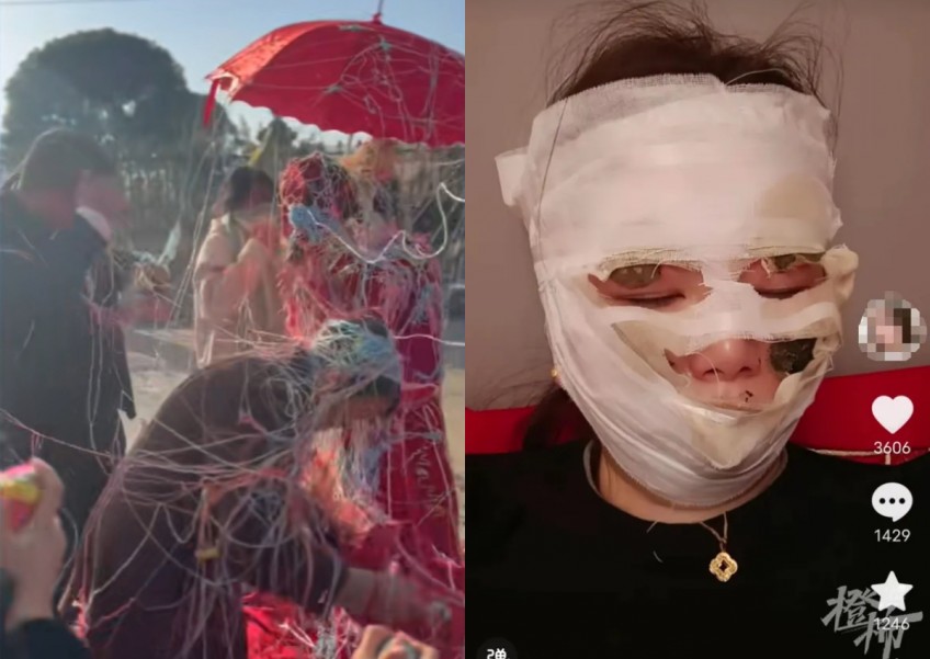 'I was nearly disfigured': Bride in China suffers burns on face after getting sprayed with streamers on wedding day