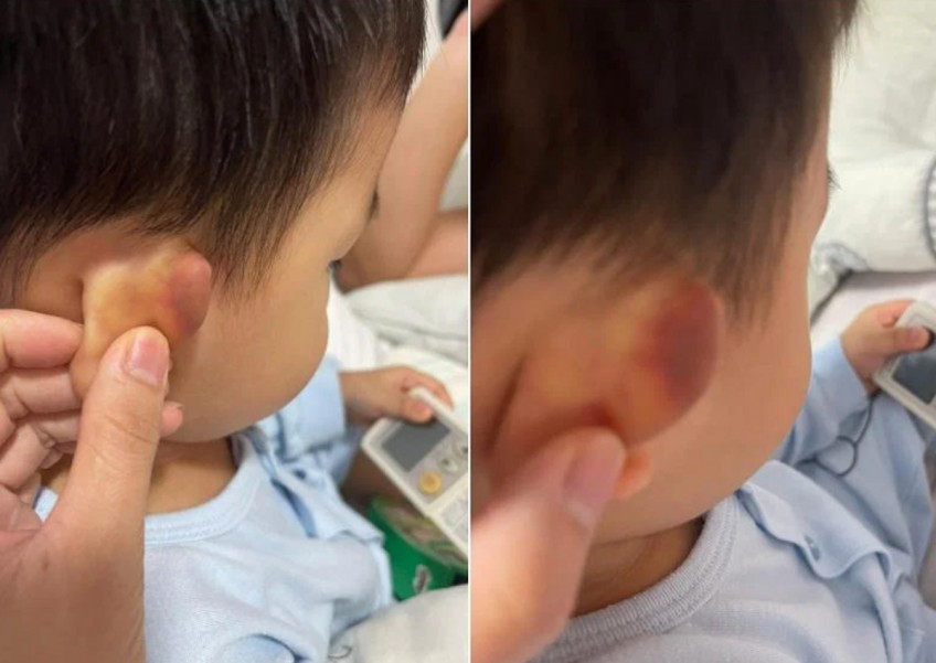 Toddler with bruised ear: ECDA reveals teacher also pushed him and caused fall