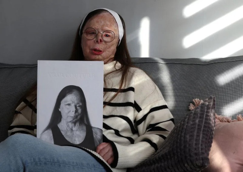 Acid attack survivor fronts fashion book in new awareness campaign