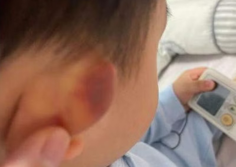 Toddler returns home from Yishun pre-school with bruise on ear; authorities investigating matter