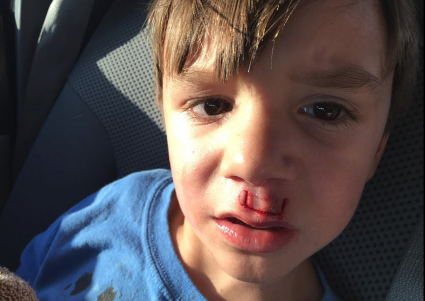 Father shares horror story of fidget spinner exploding in son's face 