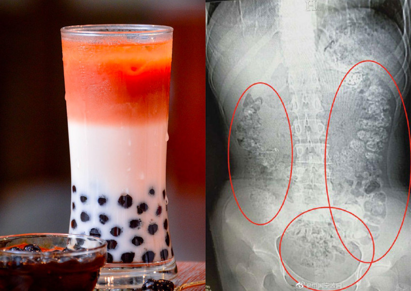 Chinese girl suffers constipation for 5 days. The cause? Bubble tea pearls