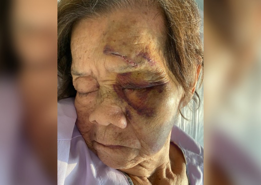 Woman, 83, falls during stay at Raffles Hospital, suffers bruises on face and 2.5cm cut above eye