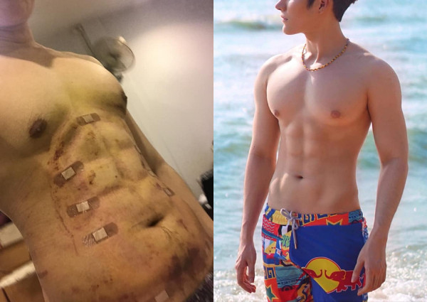 Instant six-packs now possible at this plastic surgery hospital in Bangkok