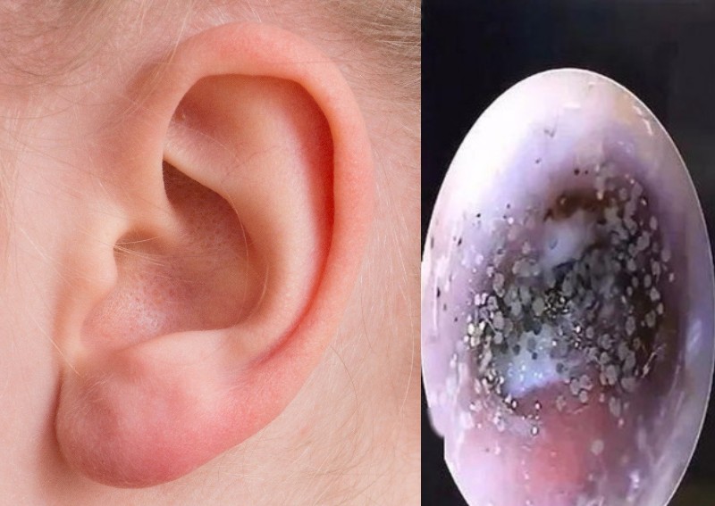 'Mould' found growing in boy's ear canal, said to be due to wearing earphones too often