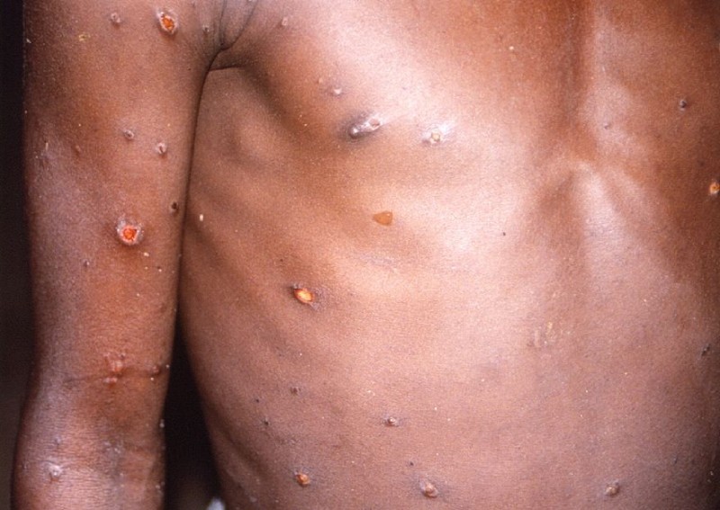 WHO expects more cases of monkeypox to emerge globally