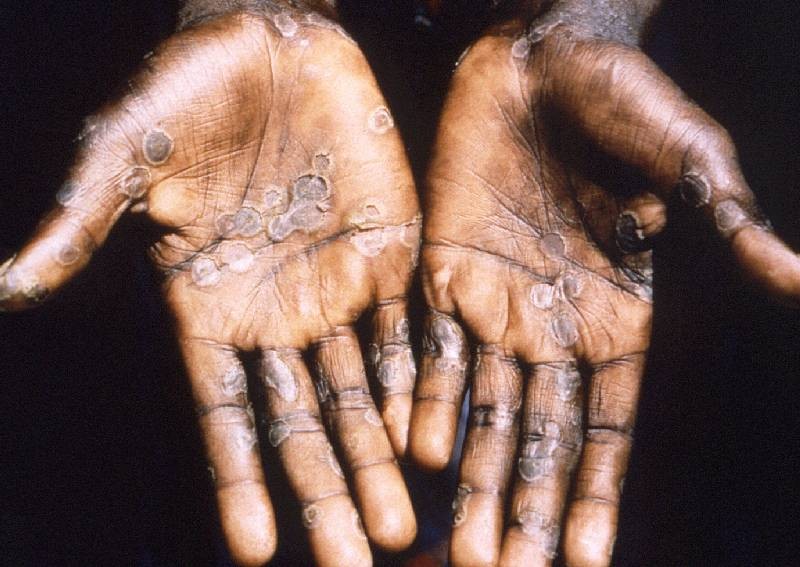 How concerned should we be about monkeypox?