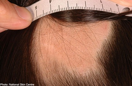 Treating hair loss in women