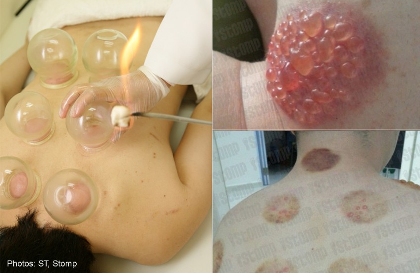 Man gets blisters when cupping treatment goes wrong