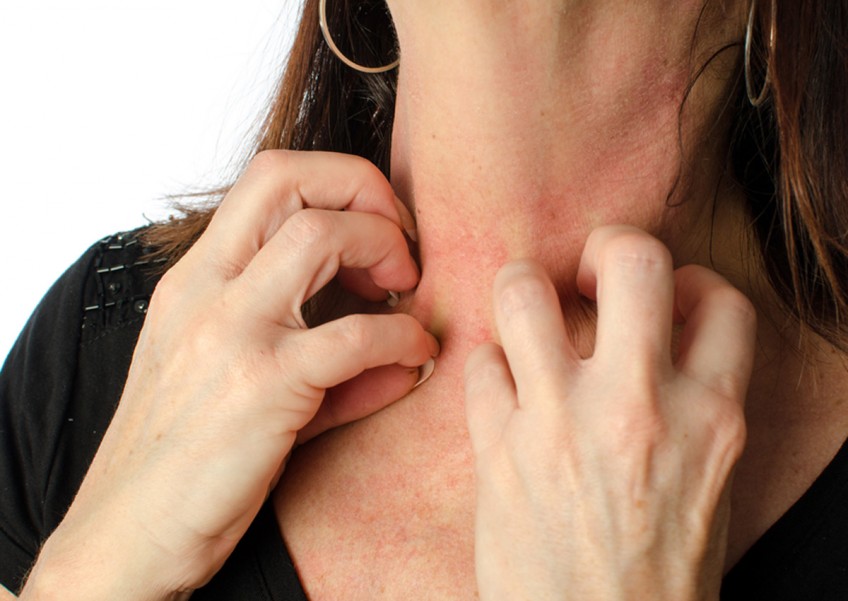 8 ways to keep eczema under control