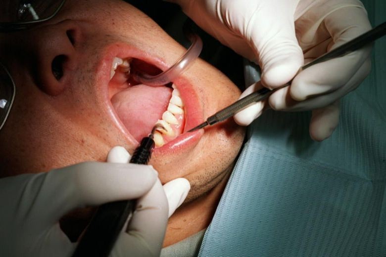 Chef's taste buds affected by wisdom tooth extraction; gets $105,000 for job loss, pain after suing dentist