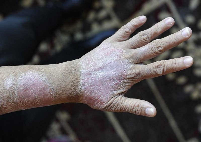 Everything you need to know about psoriasis