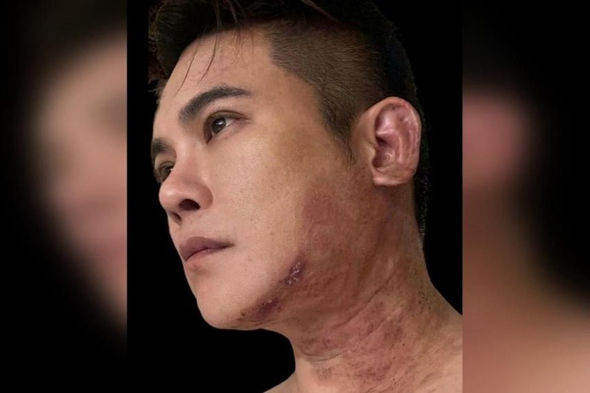 'The pain is beyond description': Actor Nick Shen shares his experience battling shingles