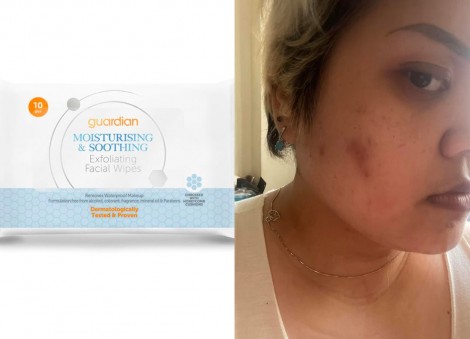 'Bloodstain on my pillow': Woman on being scarred after using facial wipes from pharmacy to clean pimples